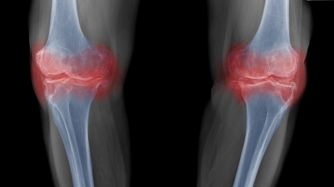 Röntgenaufnahme von den Knien. Kniegelenke rot eingefärbt. Quelle: © Choo - stock.adobe.com