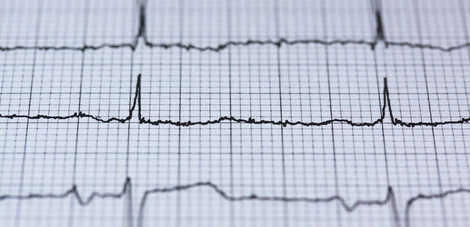 Auszug eines EKG Ausdrucks beim Arzt. Quelle: © Pixabay