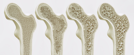 4 Stadien der Osteoporose. Quelle: © crevis - stock.adobe.com